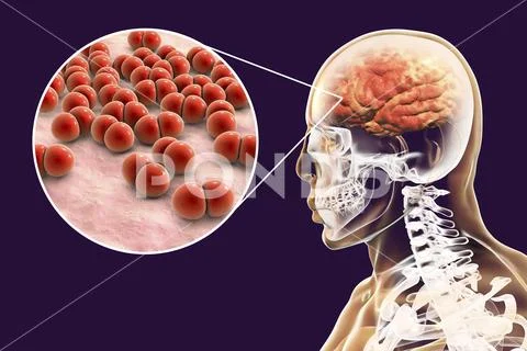 Brain infection caused by Streptococcus pneumoniae bacteria Stock Illustration