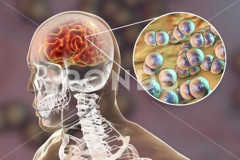 Brain infection with Neisseria meningitidis bacteria Stock Illustration