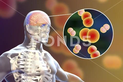 Brain infection with Neisseria meningitidis bacteria Stock Illustration