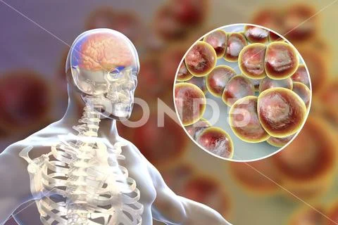 Brain infection with Neisseria meningitidis bacteria Stock Illustration