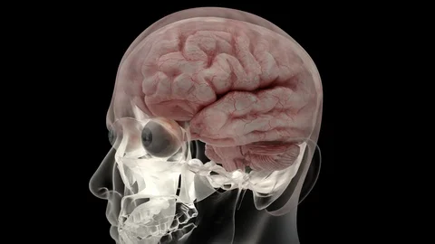 Brain insult Stock Footage 122197315