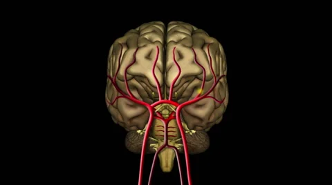 Brain ischemic stroke due to cholesterol plaque. 스톡 동영상 41731514