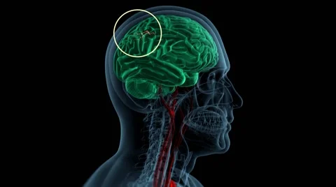 Brain ischemic stroke Stock Footage