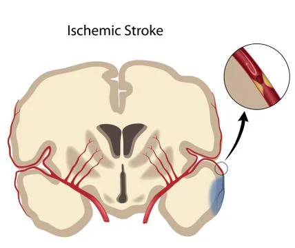 Brain ischemic stroke Stock Illustration