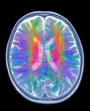 Brain MRI and white matter fibres 스톡 일러스트