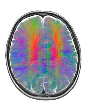 Brain MRI and white matter fibres 스톡 일러스트