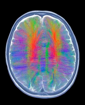 Brain MRI and white matter fibres 스톡 일러스트