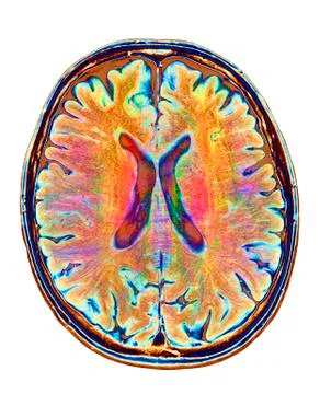 Brain MRI and white matter fibres 스톡 일러스트