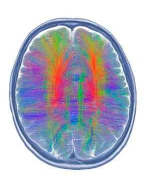 Brain MRI and white matter fibres 스톡 일러스트