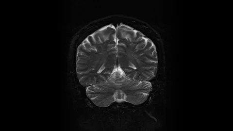 Brain MRI, head scans and tumor detectio... | Stock Video | Pond5