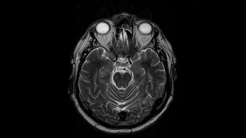 Brain MRI, head scans and tumor detection. Diagnostic medical tool Stock-Footage 121364493