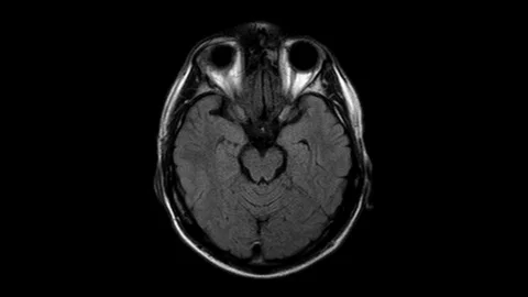 Brain MRI, head scans and tumor detection. Diagnostic medical tool Stock-Footage 121689611