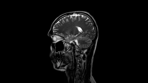 Brain MRI, head scans and tumor detection. Diagnostic medical tool Stock-Footage 121689630