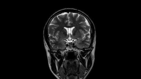 Brain MRI, head scans and tumor detection. Diagnostic medical tool Stock Footage 121689633