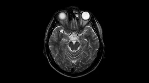Brain MRI, head scans and tumor detection. Diagnostic medical tool Stock Footage 123636324