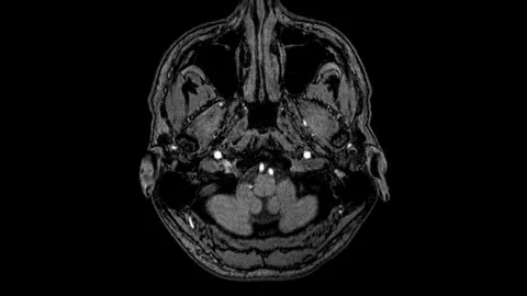 Brain MRI, head scans and tumor detection. Diagnostic medical tool Stock Footage 123772101