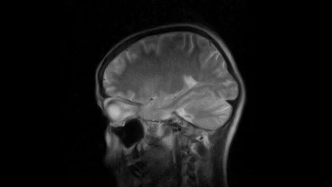 Brain MRI, head scans and tumor detection. Diagnostic medical tool Video stock 126059173