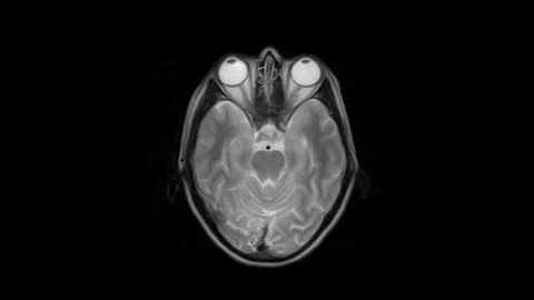 Brain MRI, head scans and tumor detection. Diagnostic medical tool Stock Footage 126204451