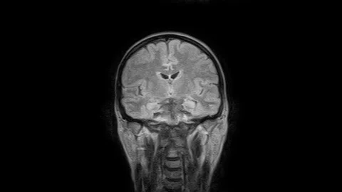 Brain MRI, head scans and tumor detection. Diagnostic medical tool Stock Footage 127089322