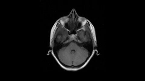 Brain MRI, head scans and tumor detection. Diagnostic medical tool Video stock 127494859
