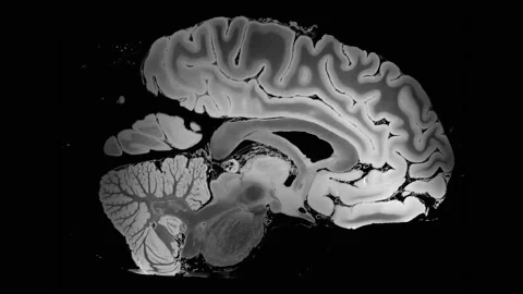Brain MRI, head scans and tumor detection. Stock Footage 236924130