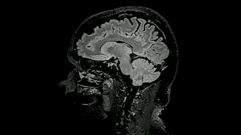 Brain MRI head scans and tumor detection black and white diagram Diagnostic Stock Footage 336561169