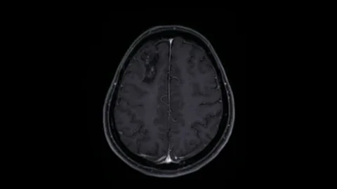 Brain MRI head scans and tumor detection black and white diagram Diagnostic 스톡 동영상 336569228