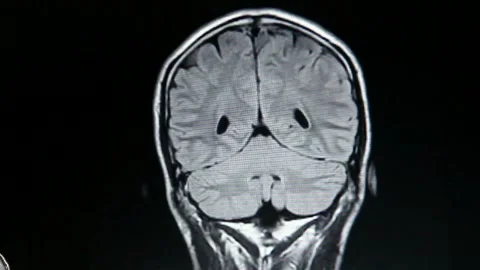 Brain MRI head scans and tumor detection black and white diagram Diagnostic 스톡 동영상 336569249