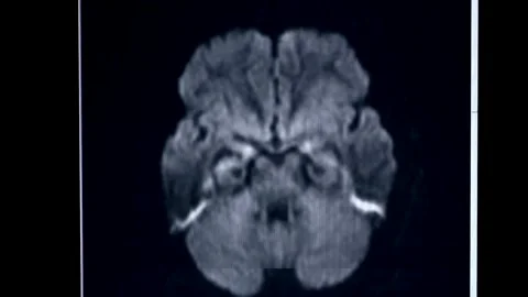 Brain MRI head scans and tumor detection black and white diagram Diagnostic 動画素材 336569301
