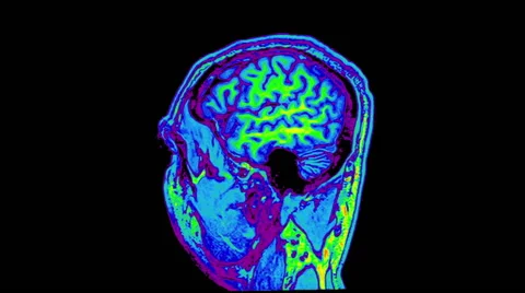 Brain MRI, sagittal view 動画素材 64802234