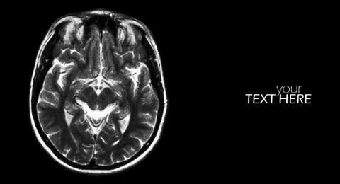 Brain MRI scan on the black Stock Photos