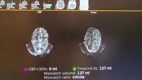 Brain Perfusion Imaging - Cerebral Angiography w CVA in Color Stock Footage 259844779