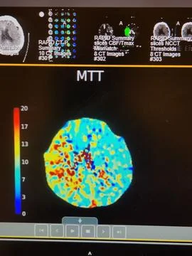 Brain Perfusion Scan - Right Middle Cerebral Artery Occlusion Stock Photos