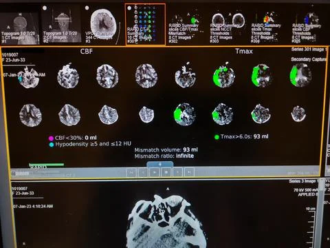 Brain Perfusion Scan - Right Middle Cerebral Artery Occlusion Stock Photos