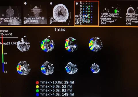 Brain Perfusion Scan - Right Middle Cerebral Artery Occlusion Stock Photos