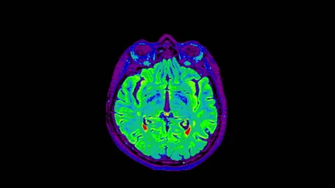 Brain Scan, Brain MR. Magnetic Resonance Imaging Of A Brain Stock Footage 194377932