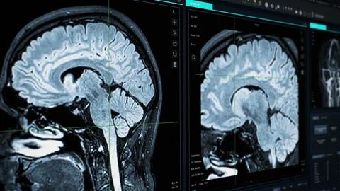 Brain Scan Medical MRI Software Stock Footage 300990062