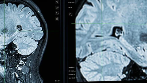 Brain Scan Medical MRI Software Stock Footage 300990152