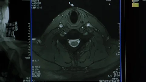 Brain Scan MRI on screen Stock Footage 123719436