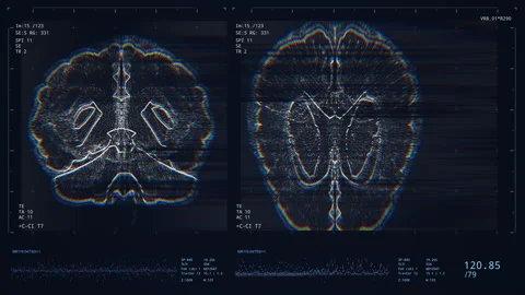 Brain scan screen animation. Diagnosis o... | Stock Video | Pond5