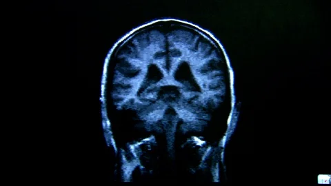 Brain scan viewed from several directions Video stock 95604057