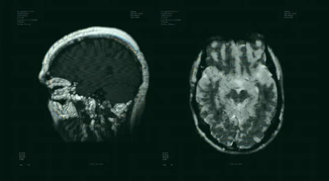 Brain scan visualization animation. Diagnosis data on laboratory display Stock Footage 158538567