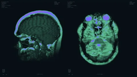 Brain scan visualization animation. Diagnosis data on laboratory display Stock Footage 158669109