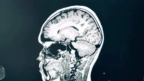 Brain scanning during an MRI procedure Stock Footage 145831678