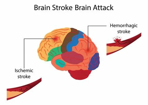 Brain stroke Brain attack, hemorrhagic stroke Stock Illustration