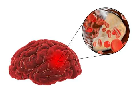 Brain stroke concept Stock Illustration