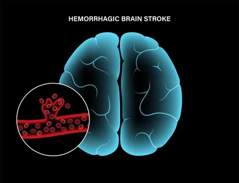 Brain stroke hemorrhagic Stock Illustration