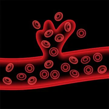 Brain stroke hemorrhagic Stock Illustration