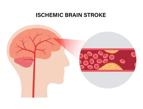 Brain stroke ishemic Stock Illustration