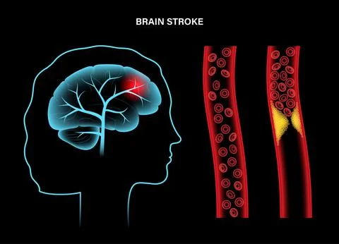 Brain stroke ishemic Stock Illustration